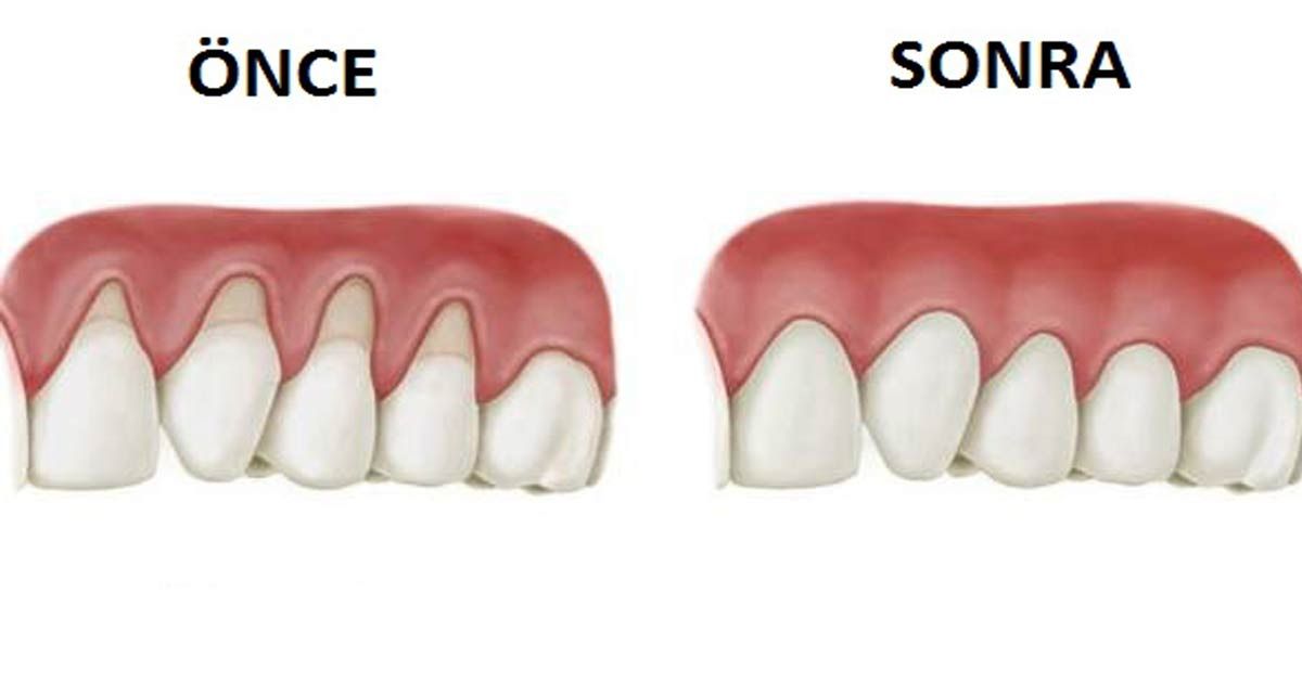 Bu Doğal tarifler ile çekilmiş diş etlerinizi geri getirin!