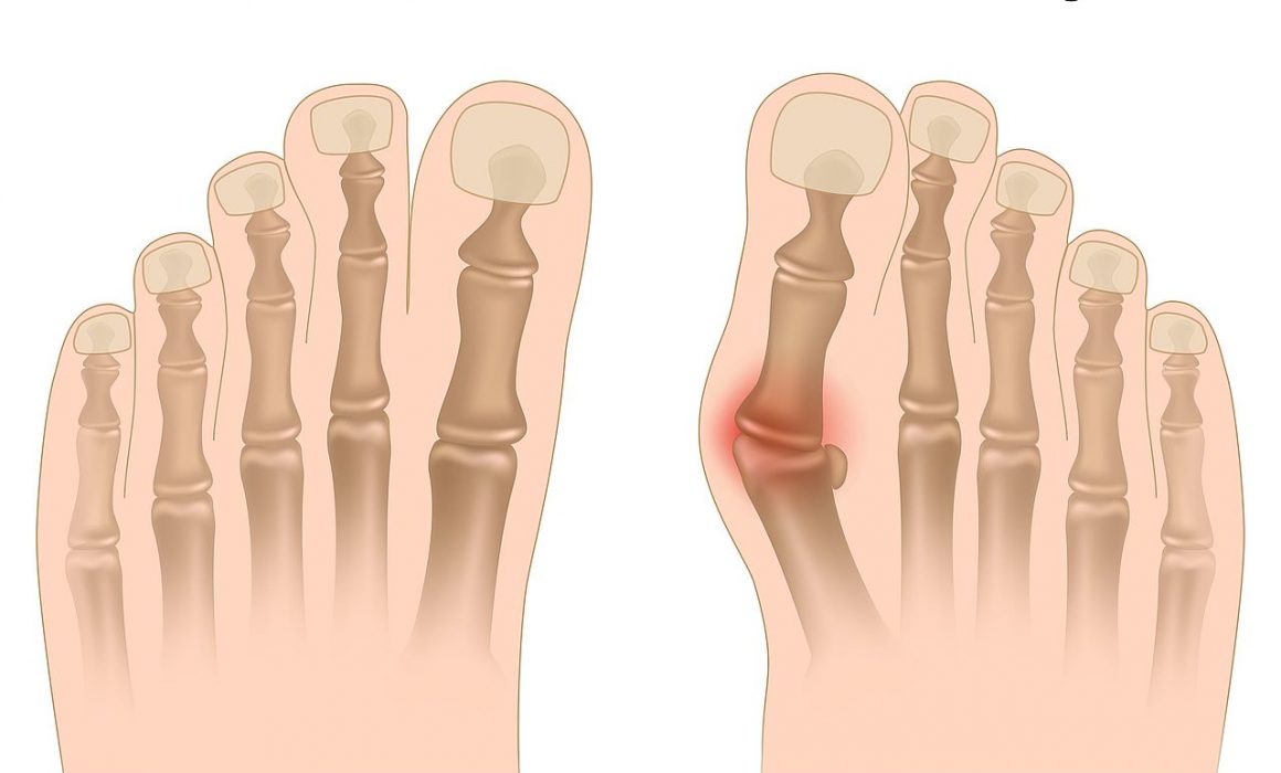Ayak Baş Parmağında Oluşan Bünyon Nasıl Doğal Olarak Geçer