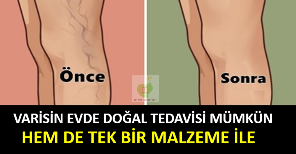 Varisin Evde Doğal Tedavisi Mümkün Hem de Tek Bir Malzeme ile