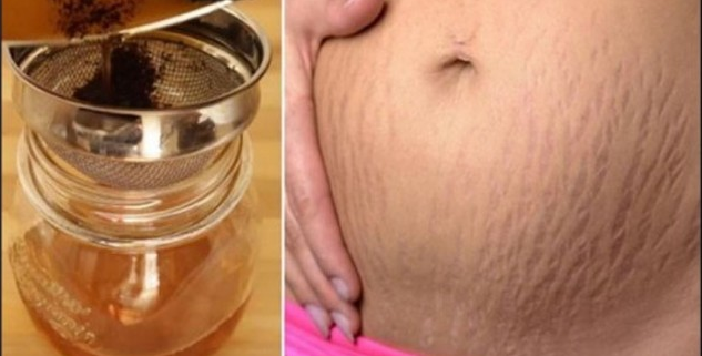 Hamilelikten Kalan Yırtık Derinizden Kurtulun!