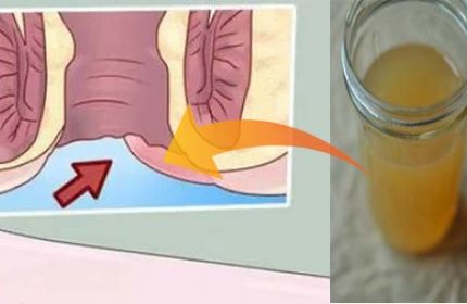 24 saatte sadece bir malzemeyle basur tedavisi!