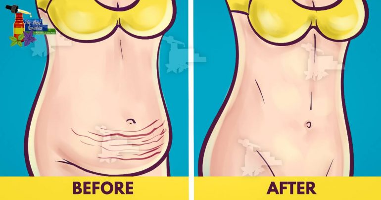 Bu tarifi 4 günden fazla tüketmeyin: Bu Karışım 4 Günde 4 kg kaybedin 4 cm incelin