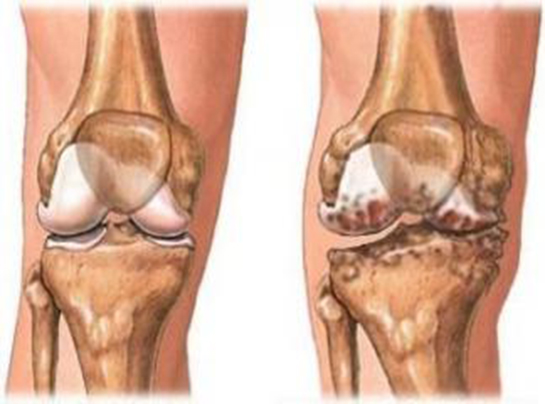Dizlerdeki Kireçlenmeye Etkili Çözüm