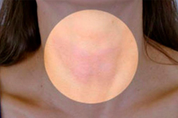 Tiroide şifa kaynağı! Bu yöntemi size asla doktorlar söylemeyecek!