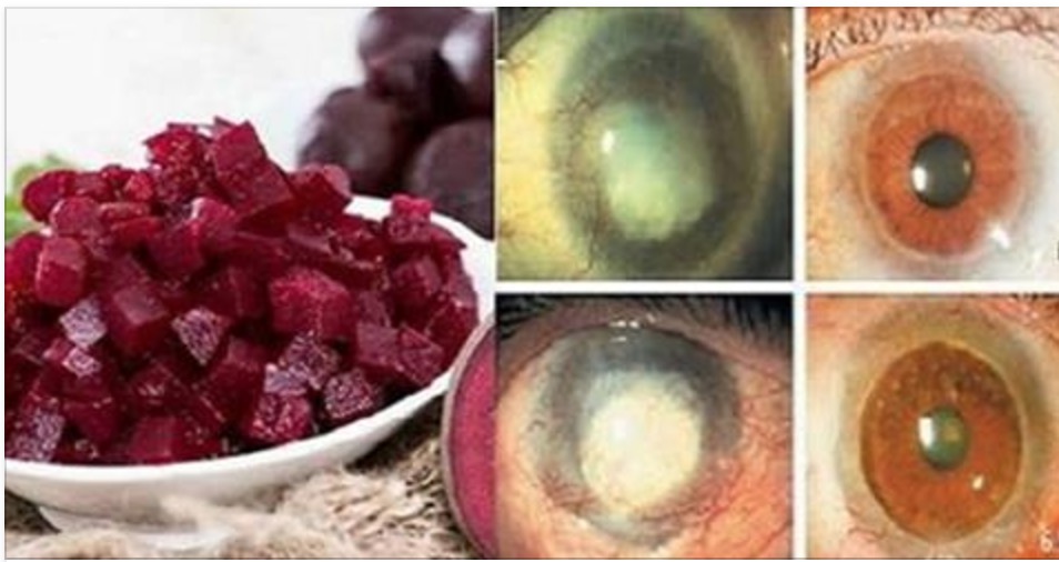Kırmızı Pancar Kürüyle gözler ve karaciğer taş gibi olacak