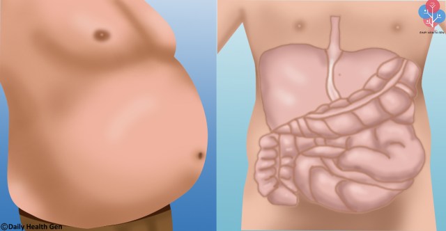 SEN ŞİŞMAN DEĞİLSİN SADECE MİDEN GAZLA DOLU!