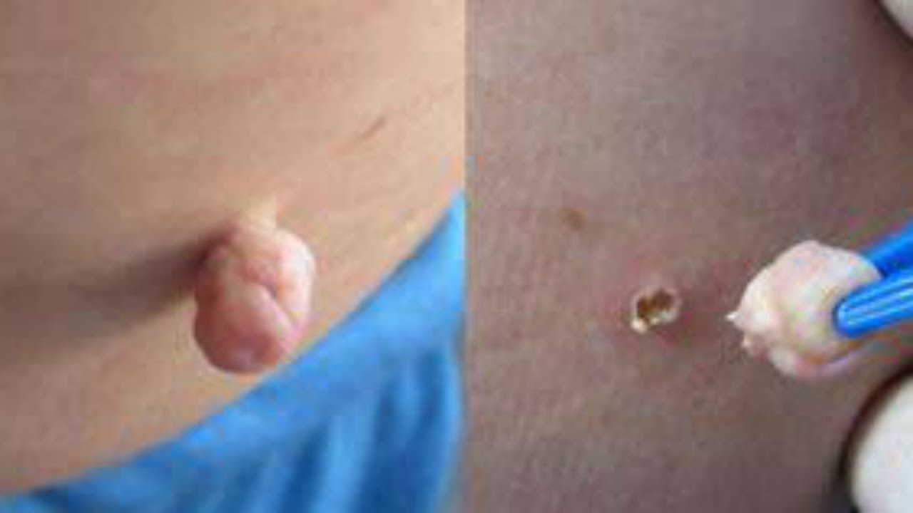 Bir kaç gün içinde siğilleri benleri cilt lekeleri döken yöntemler