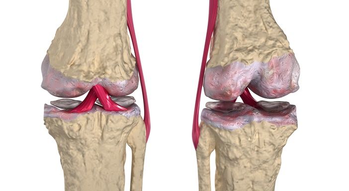 Doktorlar Şokta! Diz ve Eklemleri Yeniden Doğmuş Gibi Yapıyor!