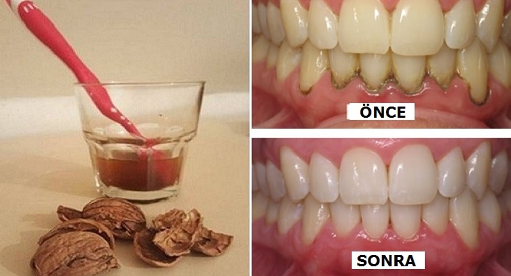 1 Malzemeyle Işık Işıl Dişler! ( Tartar, enfeksiyonlar, iltihaplı diş hastalıkları…)