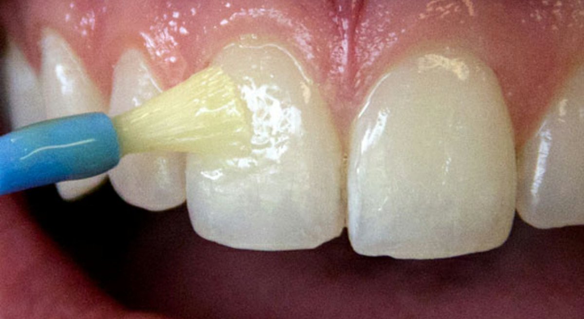 Diş minesini nasıl yeniden canlandırıp dişleri pürüzsüz bembeyaz yapabiliriz