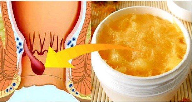 BU ACIYA SON VERİN! BU EV YAPIMI KREMLE 1 GECEDE HEMOROİDE SONSUZA KADAR SON VERİN!