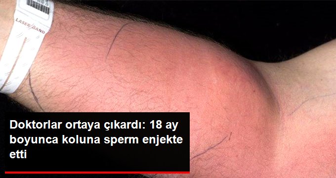 İYİLEŞMEK İÇİN KOLUNA KENDİ SPERMİNİ ENJEKTE ETTİ! HERKES ŞAŞKINA DÖNDÜ
