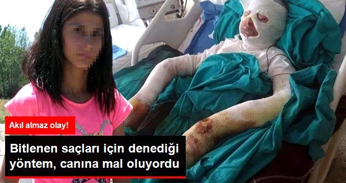 Lise Öğrencisi Gözde, Bitlenen Saçlarını Benzinle Yıkamak İsterken Kendini Yaktı