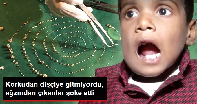 7 yaşındaki çocuğun ağzından 526 diş çıktı!