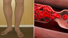 Vücudunuz Sizi Önceden Uyarıyor – Kan Pıhtılaşmasının 8 Belirtisi